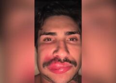 ESPECIALISTA EXPLICA RISCOS DE ESPREMER ESPINHAS APÓS CASO DE INFLUENCER